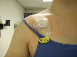 What the port looks like when accessed and ready for chemo
